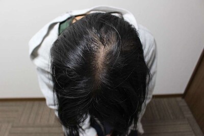 Rebirth+ミノキジェット｜20代｜4か月の症例写真[アフター]