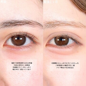 アリエル美容クリニック 大宮院の二重の症例写真