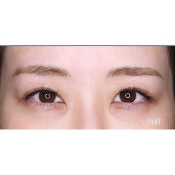 聖心美容クリニックの目元の症例写真[ビフォー]