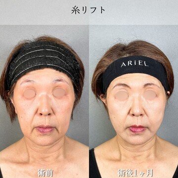 アリエル美容クリニック 大宮院のしわ・たるみ整形(注入、糸、フェイスリフト)の症例写真