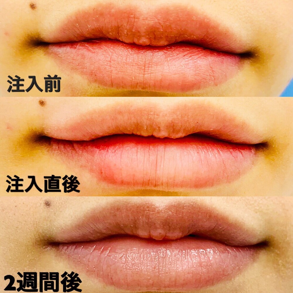 20代 女性] 【ヒアルロン酸注入】（口元・唇の整形・人中短縮）の症例写真 (CS46447)｜東京八丁堀皮膚科・形成外科《美容医療の口コミ広場》