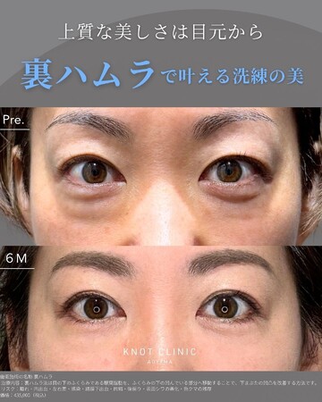 KNOT CLINIC AOYAMAの目元・クマ・眉下・涙袋整形の症例写真