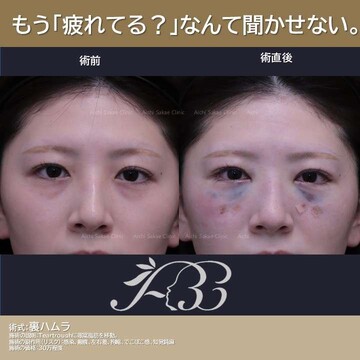あいちビューティークリニック栄本院の目元・クマ・眉下・涙袋整形の症例写真
