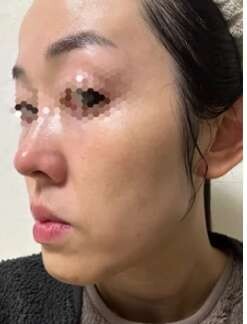 ペルラクリニック神宮前のリフトアップの症例写真[ビフォー]
