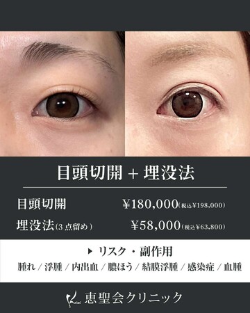 恵聖会クリニックの目・二重整形の症例写真