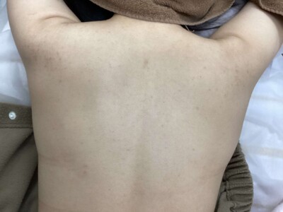 背中ニキビの治療(ケミカルピーリングなど)の症例写真[アフター]