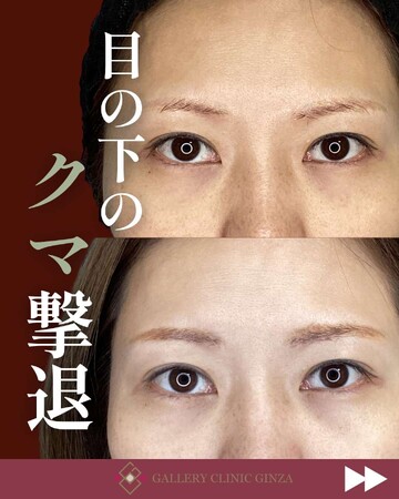 ギャラリークリニックの目元・クマ・眉下・涙袋整形の症例写真