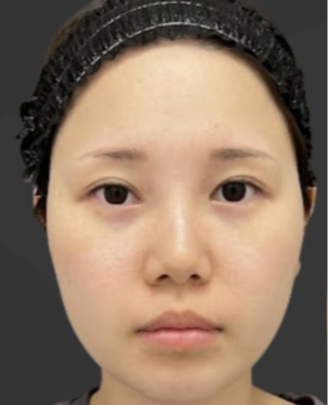 Plume Clinicの脂肪吸引の症例写真[ビフォー]