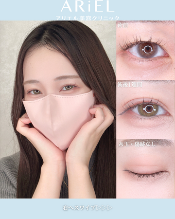 アリエル美容クリニック 横浜院の目・二重整形の症例写真