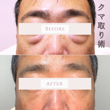 くみこクリニック 四条烏丸院の目元・クマ・眉下・涙袋整形の症例写真
