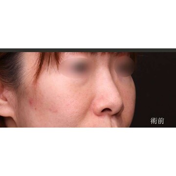 聖心美容クリニックの鼻の症例写真[ビフォー]
