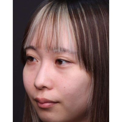 裏ハムラ法で目元のふくらみと影を改善（術後3ヶ月）の症例写真[ビフォー]