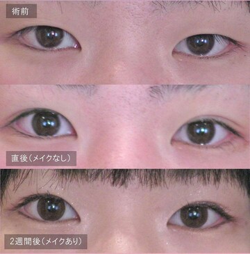 アーティスクリニックの目・二重整形の症例写真