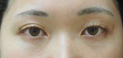 ⽬の下のクマ取り（結膜側脱脂術）の症例写真