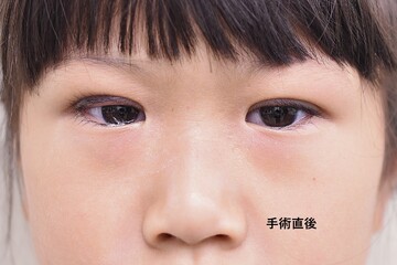 医療法人秀晄会 心斎橋コムロ美容外科クリニックの目・二重整形の症例写真[ビフォー]