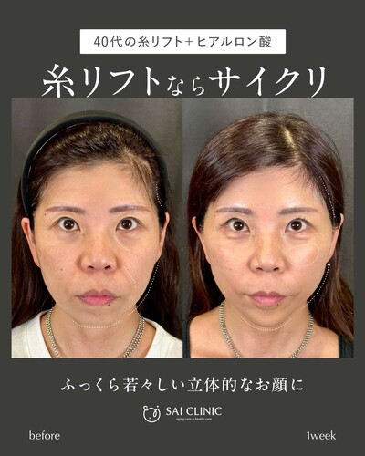 糸リフト（SAI LIFT STANDARD）＋ヒアルロン酸の症例写真