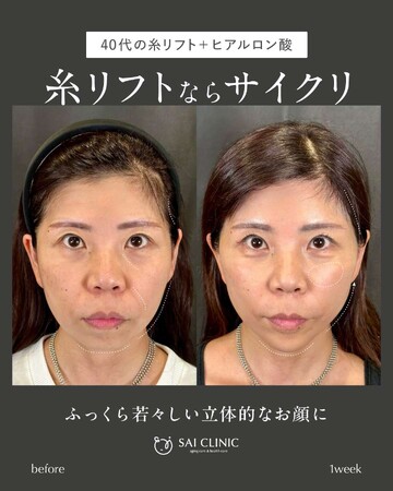 SAI CLINIC （サイクリニック）のリフトアップの症例写真