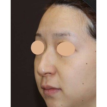 聖心美容クリニックの鼻の症例写真[ビフォー]