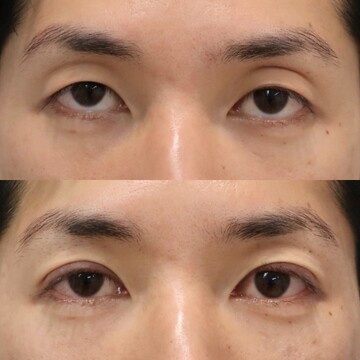 目 二重整形 男性向け の症例写真 画像 メンズ版 美容医療の口コミ広場