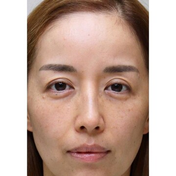 聖心美容クリニックの目元の症例写真[ビフォー]
