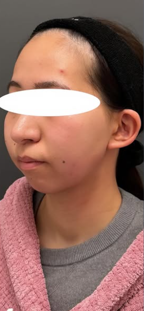 Plume Clinicのしわ・たるみ整形(注入、糸、フェイスリフト)の症例写真[ビフォー]