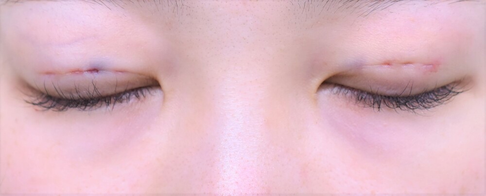 重瞼術 埋没法+脱脂(マイクロカット法)20代女性 (目・二重整形の症例写真・画像) - 医療法人秀晄会 心斎橋コムロ美容外科クリニック ...