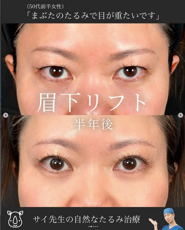 SAI CLINIC （サイクリニック）の目元・クマ・眉下・涙袋整形の症例写真