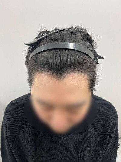 ヘアアートメイク｜20代｜2回の症例写真[アフター]