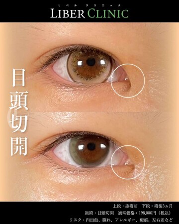 LIBER CLINIC （リベルクリニック）の目・二重整形の症例写真