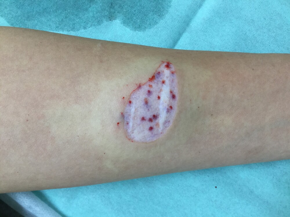 傷痕修正手術 リストカット痕 アブレーション治療 傷跡修正の症例写真 画像 福岡博多駅前通中央クリニック Cs 美容医療の口コミ広場