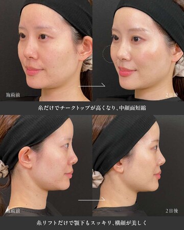 SAI CLINIC （サイクリニック）のリフトアップの症例写真