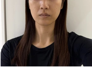 ペルラクリニック神宮前のリフトアップの症例写真[ビフォー]