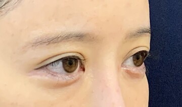 タウン形成外科クリニックの目・二重整形の症例写真[ビフォー]