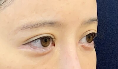 他院目頭切開術後の症例写真[ビフォー]