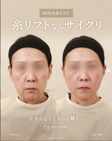 SAI CLINIC （サイクリニック）のリフトアップの症例写真
