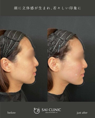 SAI CLINIC （サイクリニック）のリフトアップの症例写真