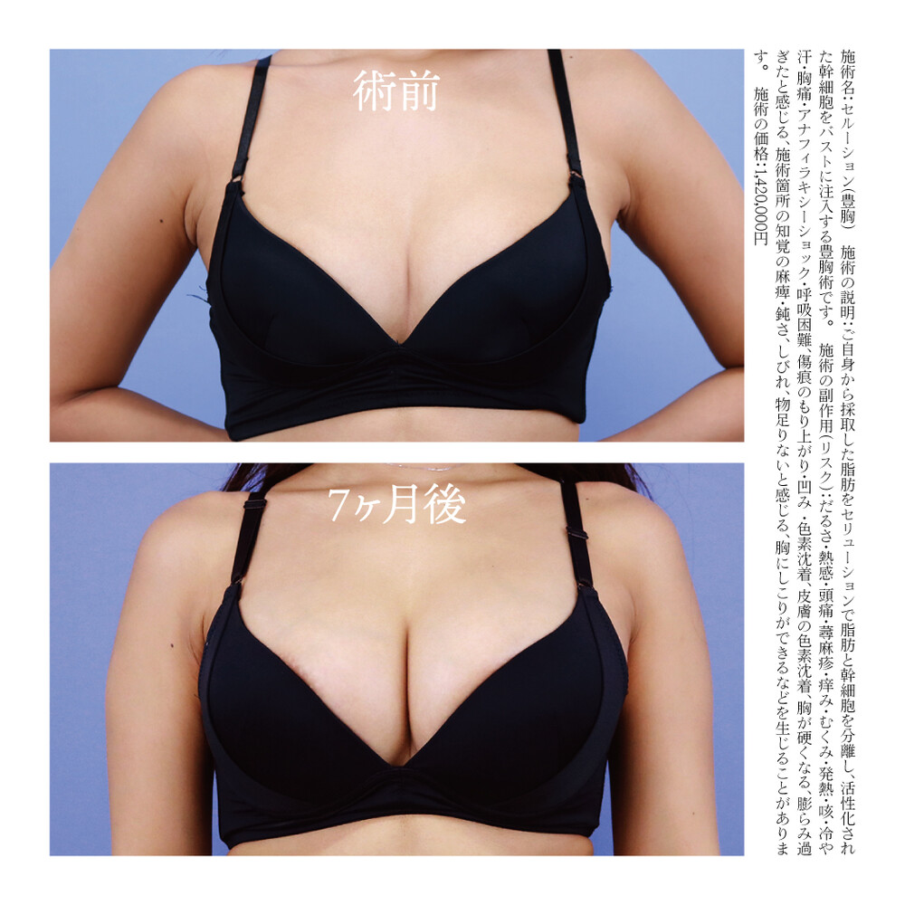 豊胸　術前 セルーション豊胸 / 術前→7ヶ月後 (脂肪注入（豊胸）の症例写真・画像) - 湘南美容クリニック 新宿本院 (CS44164)《美容医療の口コミ広場》