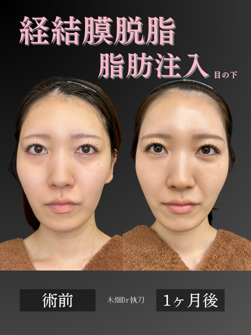 CHARIS BEAUTY CLINICの目元・クマ・眉下・涙袋整形の症例写真