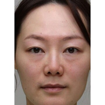 聖心美容クリニックの目元の症例写真[ビフォー]
