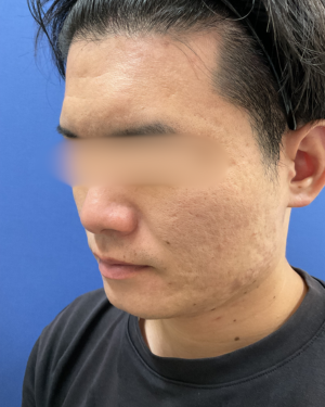 フェミークリニックの症例写真[アフター]