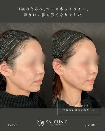 SAI CLINIC （サイクリニック）のリフトアップの症例写真
