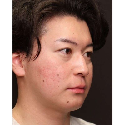 男性の裏ハムラ法で疲れ顔の目元を改善（術後3ヶ月）の症例写真[ビフォー]