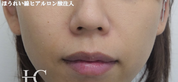 静岡美容外科橋本クリニックのしわ・たるみ整形(注入、糸、フェイスリフト)の症例写真[ビフォー]