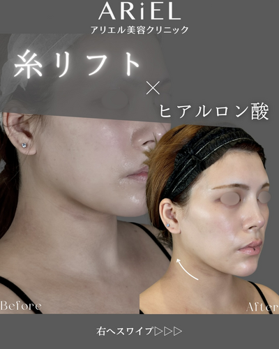 糸リフト/顎ヒアルロン酸の症例写真