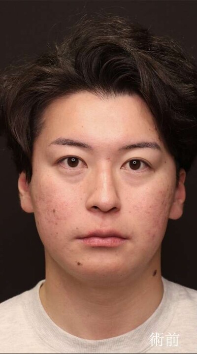 裏ハムラ法で男性の目の下のクマ・疲れ顔を改善（術後1ヶ月）の症例写真[ビフォー]