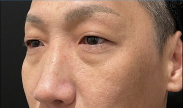 目の下のクマ取りクリニック 大阪梅田の目元・クマ・眉下・涙袋整形の症例写真[ビフォー]