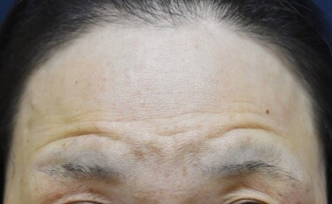 しわボトックス（額）の症例写真[アフター]