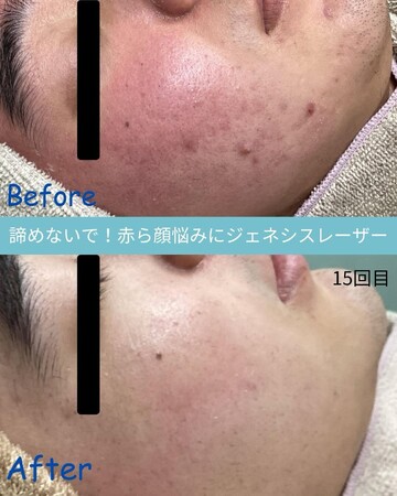 くみこクリニック 四条烏丸院のシミ取り・肝斑・毛穴治療の症例写真