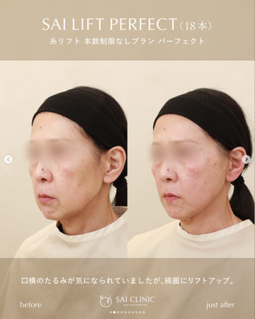 SAI CLINIC （サイクリニック）のリフトアップの症例写真