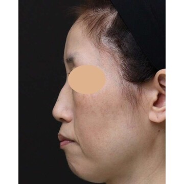 聖心美容クリニックのリフトアップの症例写真[ビフォー]